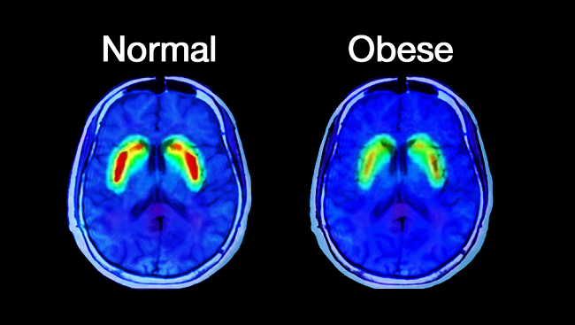 obesity-brain-scan
